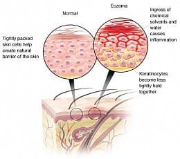 What causes eczema? - and is there a cure?
