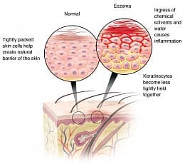 What Causes Eczema And Is There A Cure Life Energy Designs