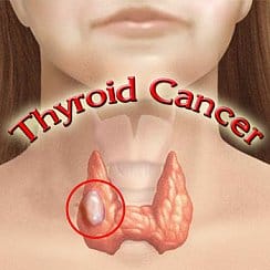 Link between EMF and Thyroid cancer